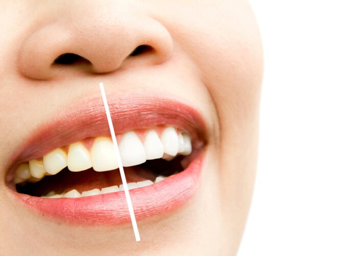 Clínica Doctor Melwani - blanqueamiento dental